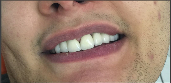 Caso 2 lentes de contato dental e clareamento dental depois