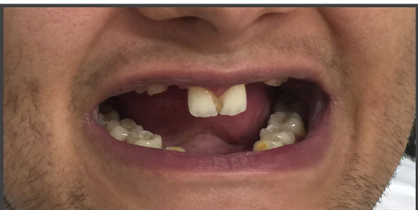 Caso 2 lentes de contato dental e clareamento dental antes